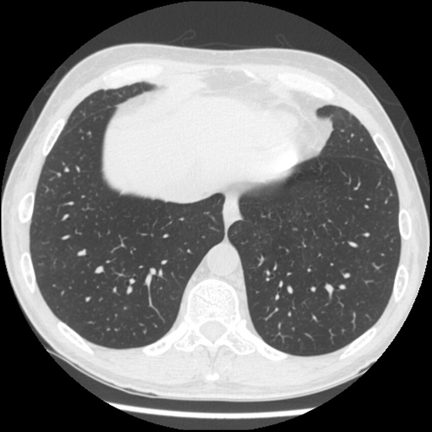 Angioinvasive aspergillosis (Radiopaedia 43957-47466 Axial lung window 55).jpg