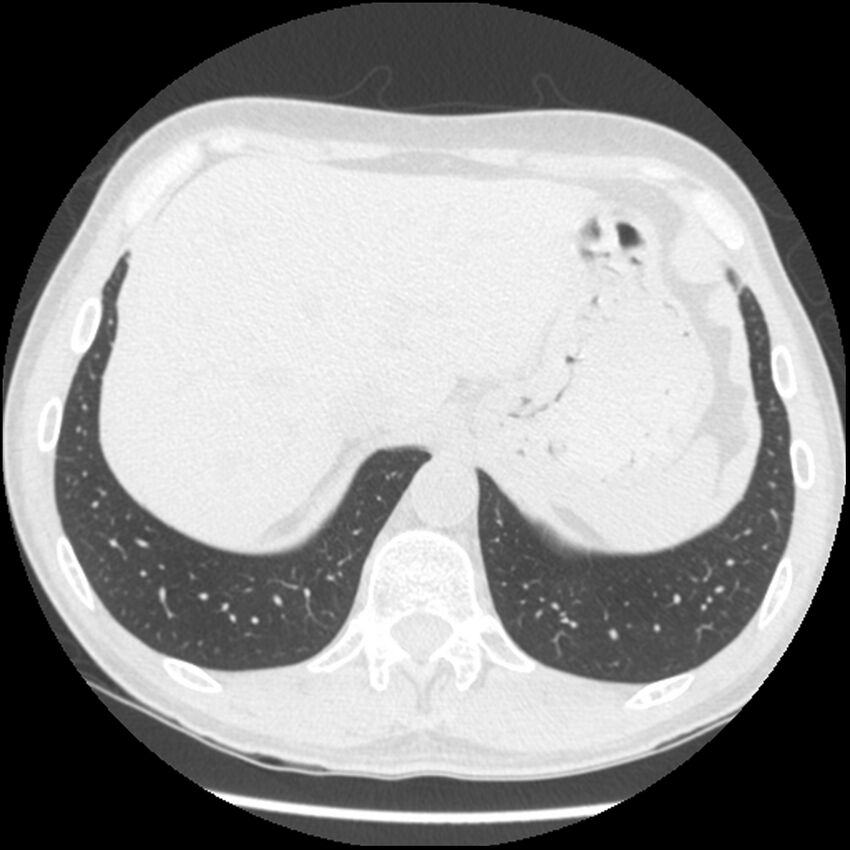 Angioinvasive aspergillosis (Radiopaedia 43957-47466 Axial lung window 61).jpg