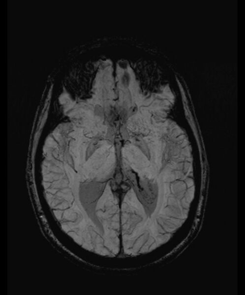 File:Angiomatous meningioma (Radiopaedia 79459-92579 E 33).jpg