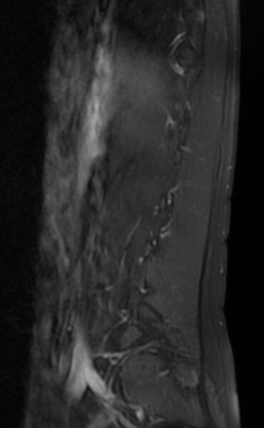 File:Ankylosing spondylitis - Andersson lesion (Radiopaedia 81878-95838 F 2).jpg