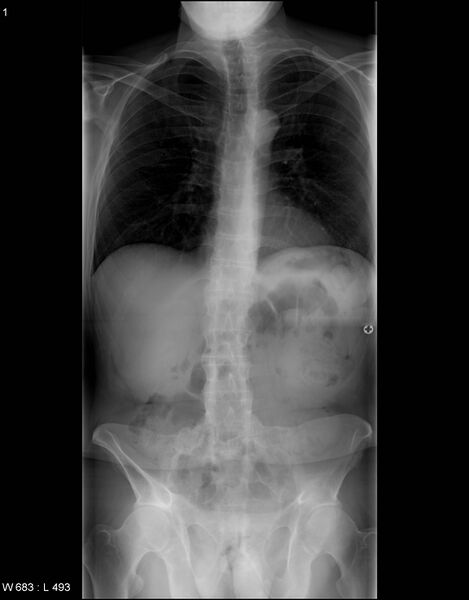 File:Ankylosing spondylitis - full spine (Radiopaedia 5614-7334 Frontal 1).jpg