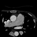 Anomalous left coronary artery from the pulmonary artery (ALCAPA) (Radiopaedia 40884-43586 A 2).jpg