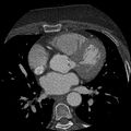 Anomalous origin of left circumflex artery from right coronary sinus (Radiopaedia 72563-83117 B 62).jpg