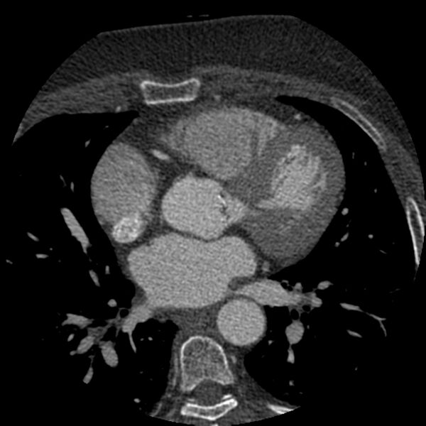 File:Anomalous origin of left circumflex artery from right coronary sinus (Radiopaedia 72563-83117 B 62).jpg