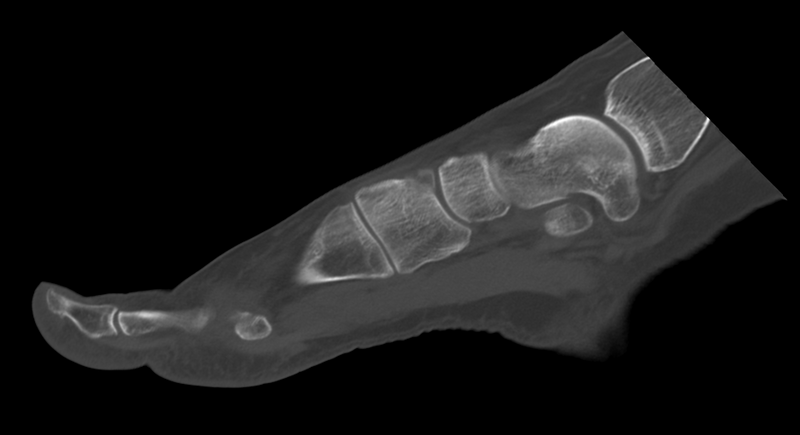 File:Anterior calcaneal process fracture (Radiopaedia 47384-51989 Sagittal bone window 22).png
