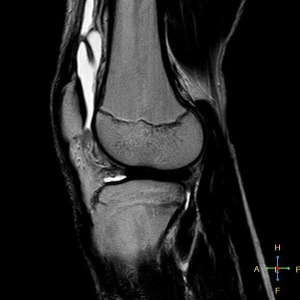 File:Anterior cruciate ligament tear - complete (Radiopaedia 24907-25170 Sagittal T2 5).jpg