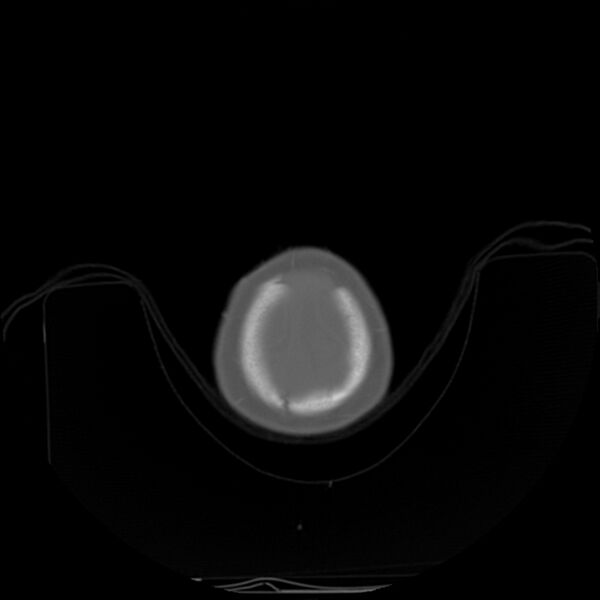 File:Anterior plagiocephaly (Radiopaedia 71836-82273 C 100).jpg