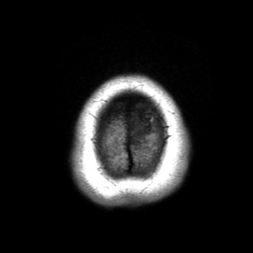 Anti-MOG encephalomyelitis (Radiopaedia 73831-84646 Axial T1 49).jpg