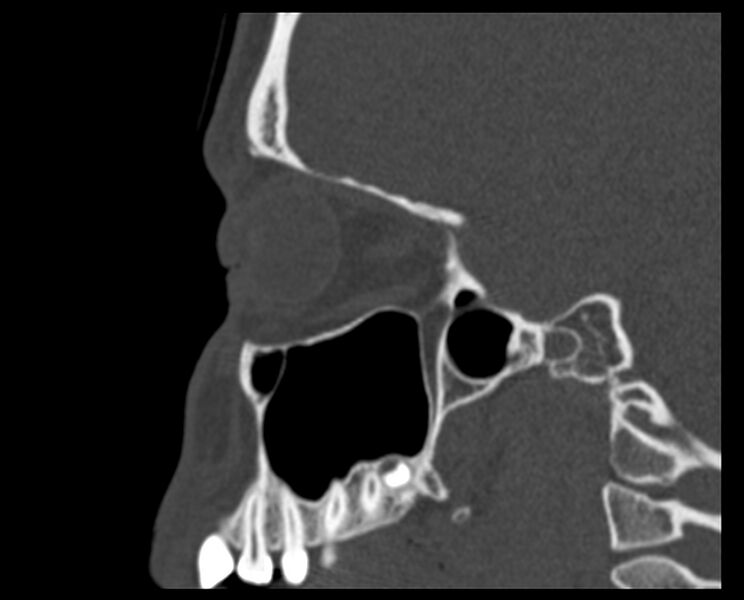 File:Antrochoanal polyp (Radiopaedia 21894-21868 Sagittal bone window 30).jpg