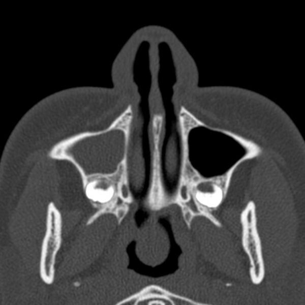File:Antrochoanal polyp (Radiopaedia 33984-35202 Axial bone window 12).jpg