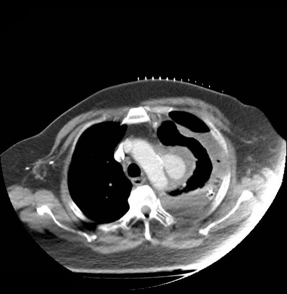 File:Aortic arch false aneurysm (Radiopaedia 14667-14588 A 5).jpg