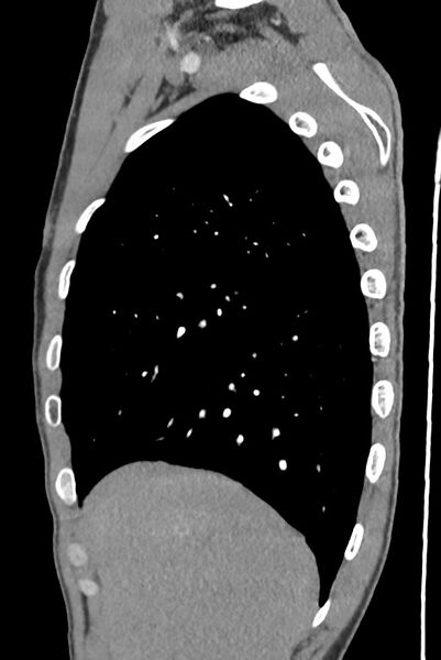 File:Aortic coarctation with aneurysm (Radiopaedia 74818-85828 B 38).jpg