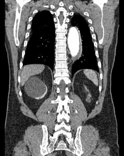 File:Aortic dissection (Radiopaedia 44411-48061 A 54).jpg