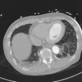 Aortic dissection - DeBakey type II (Radiopaedia 64302-73082 Axial lung window 48).png