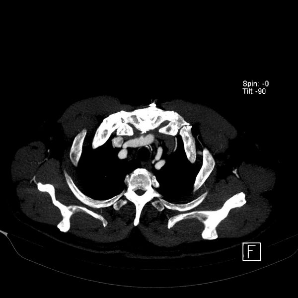 File:Aortic dissection - De Bakey type III - Stanford B (Radiopaedia 21903-21882 B 10).jpg