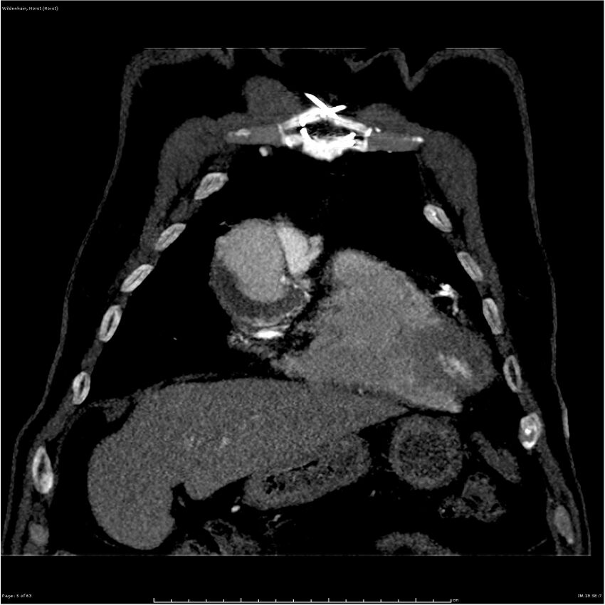 Aortic dissection - Stanford type A (Radiopaedia 26183-26315 A 5).jpg