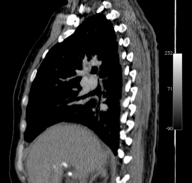 File:Aortic dissection - Stanford type A (Radiopaedia 29247-29659 C 40).jpg