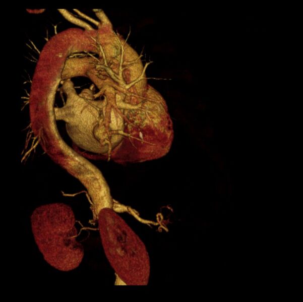 File:Aortic dissection with rupture into pericardium (Radiopaedia 12384-12647 D 14).jpg