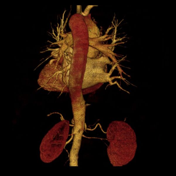 File:Aortic dissection with rupture into pericardium (Radiopaedia 12384-12647 D 21).jpg