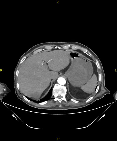 File:Aortoenteric fistula (Radiopaedia 84308-99603 B 46).jpg