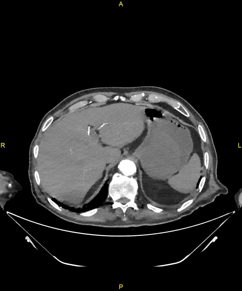 Aortoenteric fistula (Radiopaedia 84308-99603 B 46).jpg