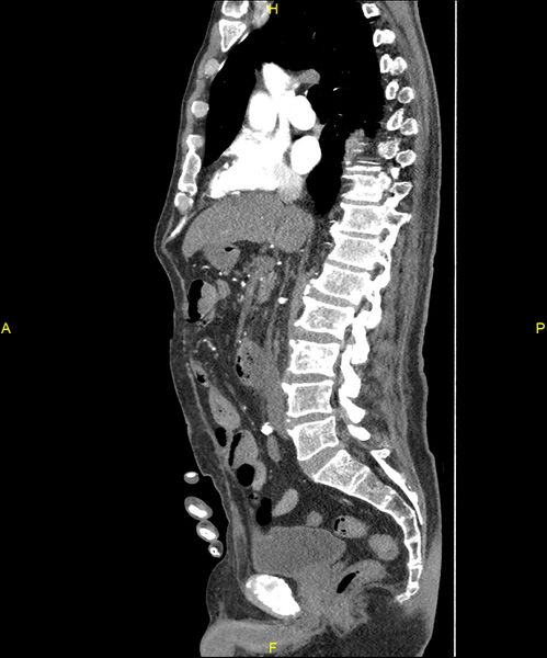File:Aortoenteric fistula (Radiopaedia 84308-99603 C 162).jpg