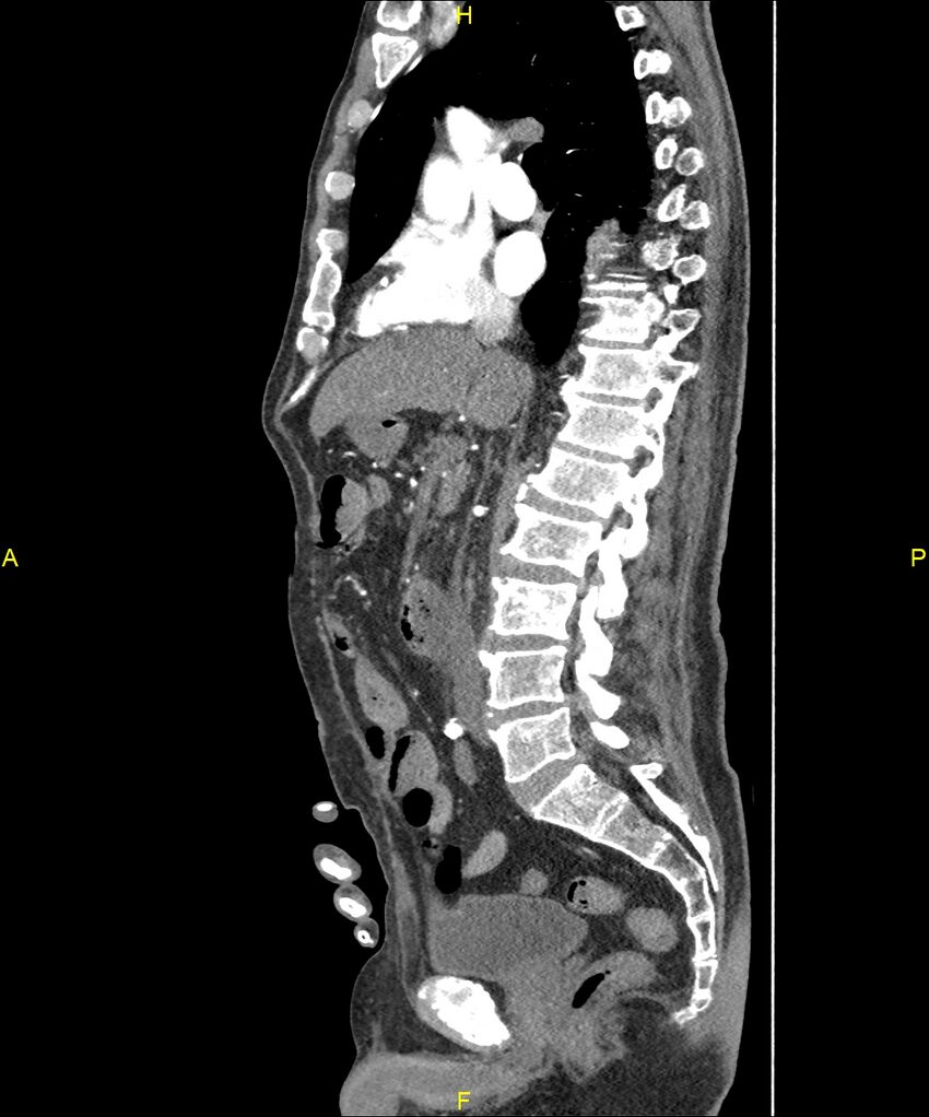 Aortoenteric fistula (Radiopaedia 84308-99603 C 162).jpg