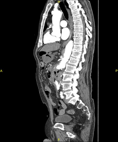 File:Aortoenteric fistula (Radiopaedia 84308-99603 C 186).jpg
