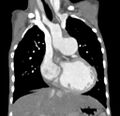 Aortopulmonary window, interrupted aortic arch and large PDA giving the descending aorta (Radiopaedia 35573-37074 D 27).jpg