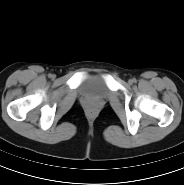 File:Appendicitis and incidental bicornuate uterus (Radiopaedia 22833-22853 Axial non-contrast 47).jpg