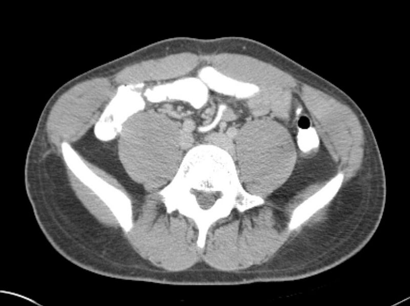 File:Appendicitis and incidental foregut duplication cyst (Radiopaedia 52962-58916 A 57).jpg