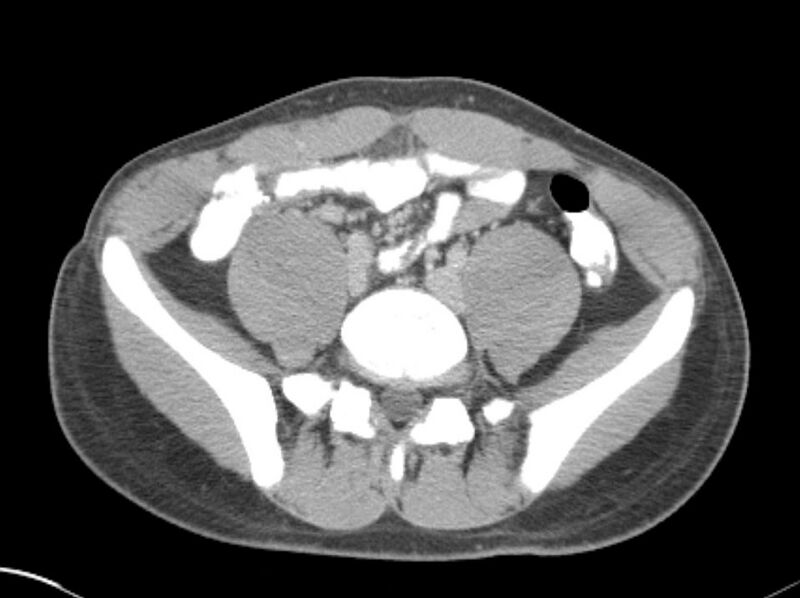 File:Appendicitis and incidental foregut duplication cyst (Radiopaedia 52962-58916 A 61).jpg
