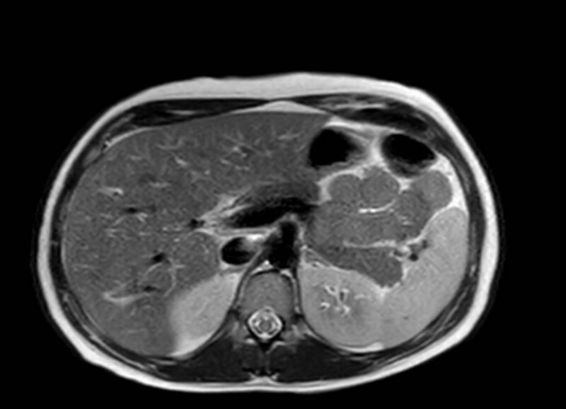 File:Appendicitis in gravida (MRI) (Radiopaedia 89433-106395 Axial T2 16).jpg