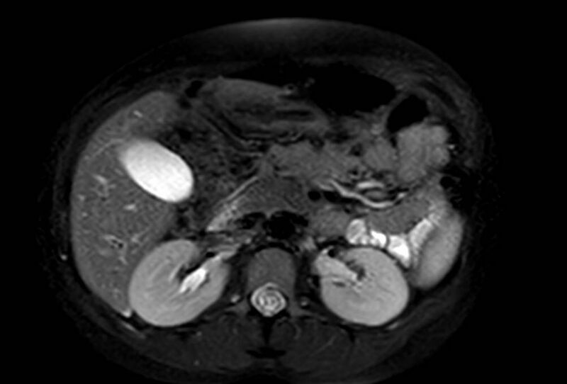 File:Appendicitis in gravida (MRI) (Radiopaedia 89433-106395 Axial T2 SPAIR 27).jpg