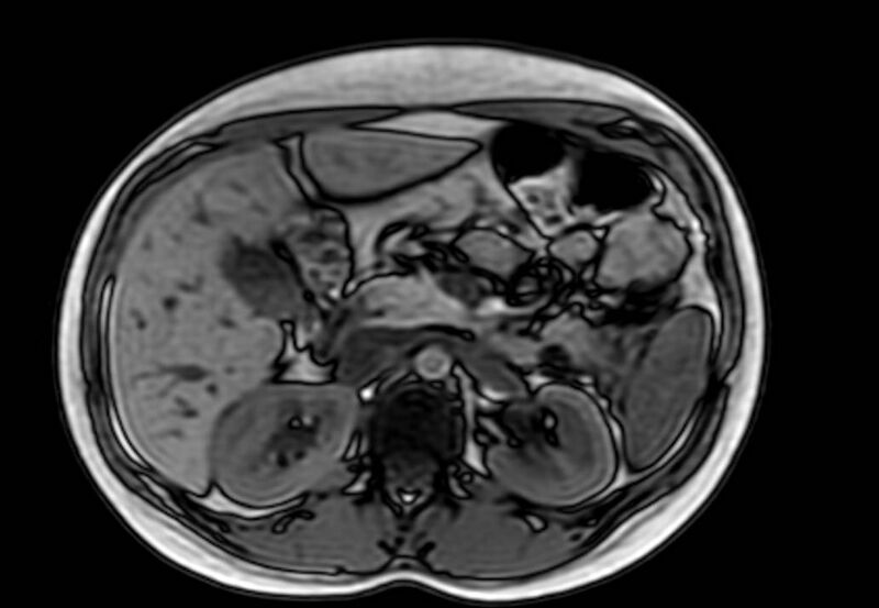 File:Appendicitis in gravida (MRI) (Radiopaedia 89433-106395 D 20).jpg