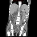 Appendicitis with phlegmon (Radiopaedia 9358-10046 B 44).jpg