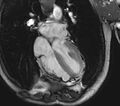 Arrhythmogenic right ventricular cardiomyopathy (Radiopaedia 39806-42237 D 47).jpg