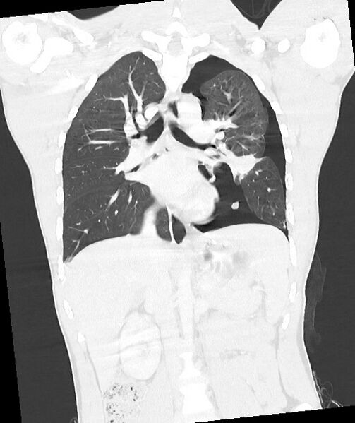 File:Arrow injury to the chest (Radiopaedia 85367-100975 Coronal lung window 79).jpg