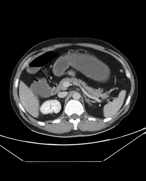 File:Arterial occlusive mesenteric ischemia (Radiopaedia 84641-100054 A 39).jpg