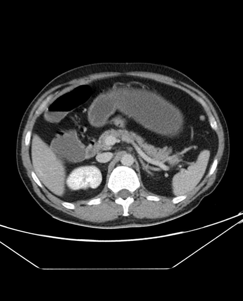 Arterial occlusive mesenteric ischemia (Radiopaedia 84641-100054 A 39).jpg