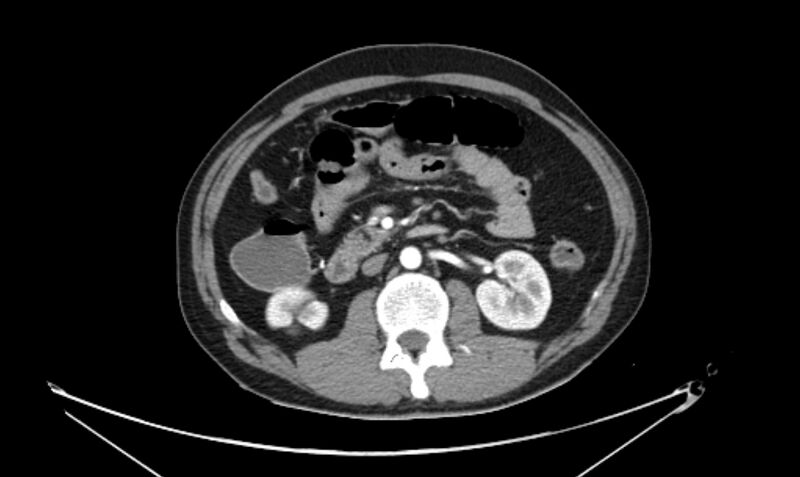 File:Arterial occlusive mesenteric ischemia (Radiopaedia 84641-100060 A 60).jpg
