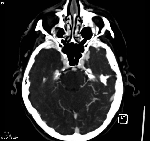 File:Arteriovenous malformation - cerebral (Radiopaedia 8172-14682 A 5).jpg