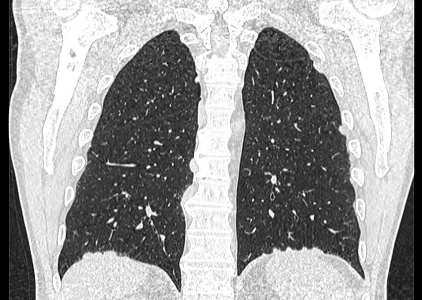 Asbestos pleural placques (Radiopaedia 57905-64872 Coronal lung window 219).jpg