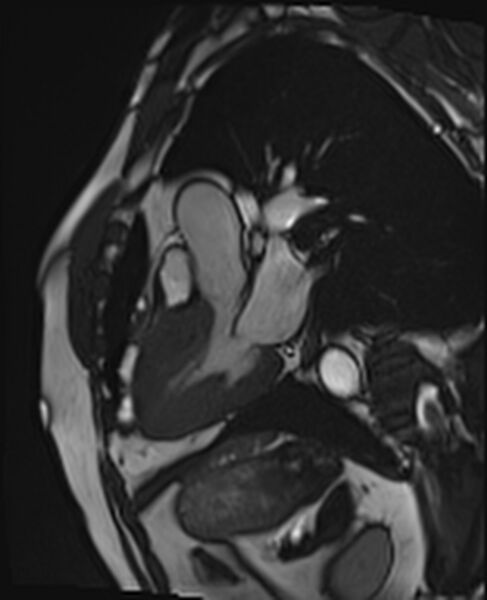 File:Asymmetric septal hypertrophic cardiomyopathy - systolic anterior motion of mitral leaflet (Radiopaedia 72795-83445 B 16).jpg