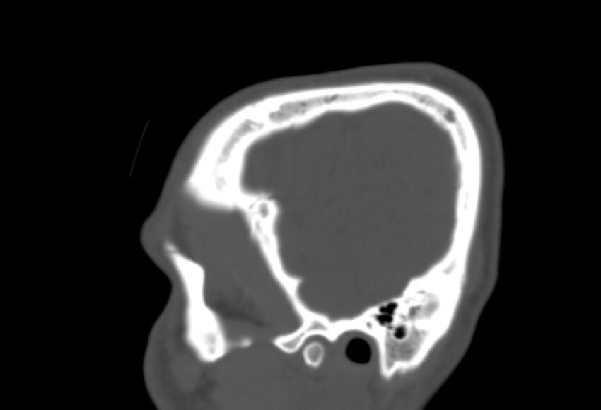 Asymptomatic occipital spur (Radiopaedia 87753-104201 Sagittal bone window 24).jpg