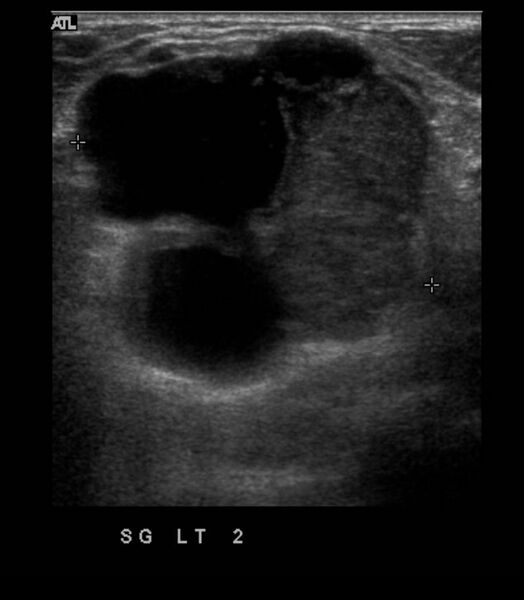 File:Atypical breast cyst- adenocarcinoma (Radiopaedia 18519).JPG