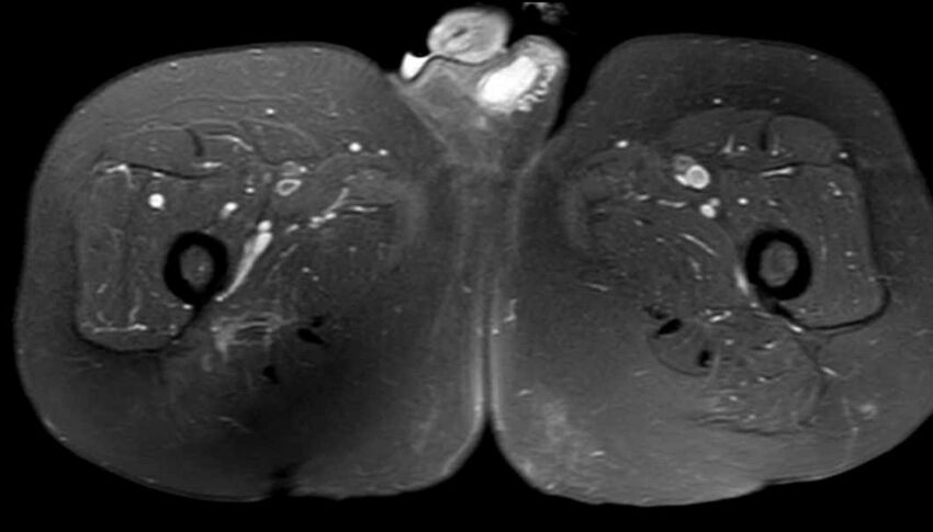 Atypical lipomatous tumor - thigh (Radiopaedia 68975-78734 Axial PD fat sat 70).jpg