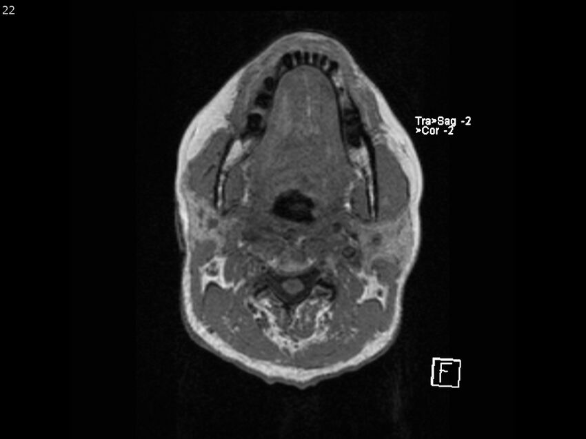 Atypical meningioma - intraosseous (Radiopaedia 64915-74572 Axial T1 22).jpg