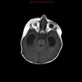 Atypical teratoid rhabdoid tumor (Radiopaedia 10712-11183 Axial T1 12).jpg