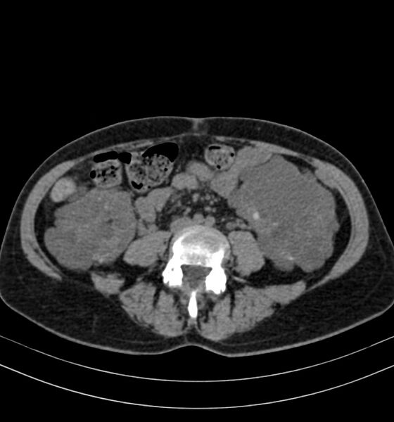 File:Autosomal dominant polycystic kidney disease (Radiopaedia 41918-44922 Axial non-contrast 20).jpg
